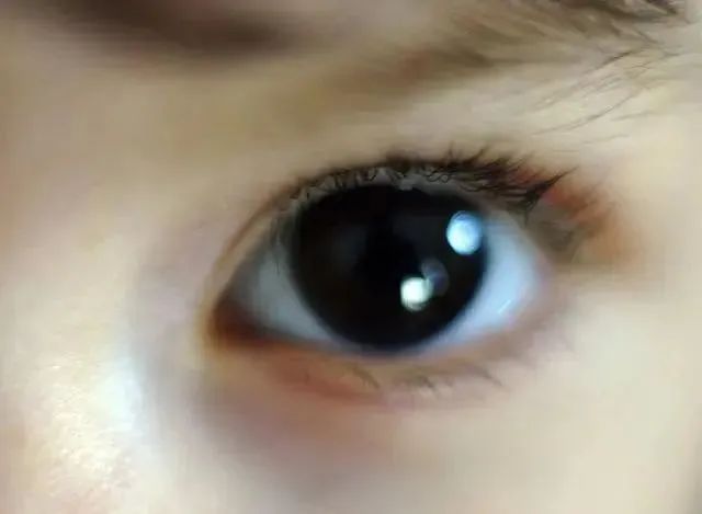 眼睛出现这三个异常，警惕癌症来临